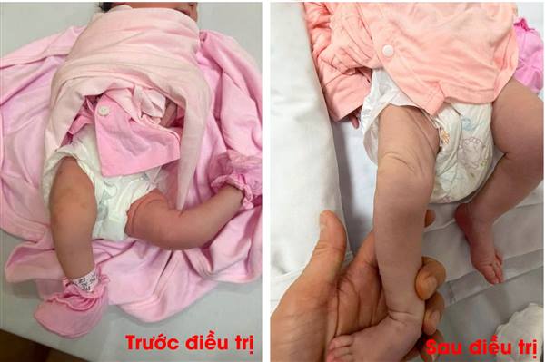 Bệnh viện Nhi Hải Phòng nắn chỉnh thành công ca biến dạng khớp gối duỗi quá mức bẩm sinh