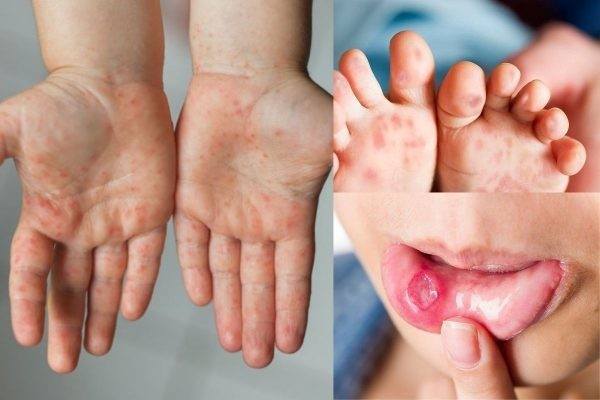 Công văn v/v tăng cường phòng, chống bệnh bại liệt, bệnh tay chân miệng và các bệnh truyền nhiễm trong cộng đồng, cơ sở giáo dục