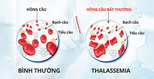 Gánh nặng bệnh tan máu bẩm sinh