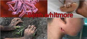 Đẩy mạnh tuyên truyền phòng, chống bệnh Whitmore .CÔNG AN BẠC LIÊU