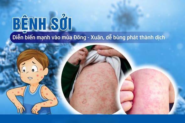 XÃ HẢI HƯNG TĂNG CƯỜNG CÔNG TÁC PHÒNG, CHỐNG BỆNH SỞI VÀ ĐẢM BẢO TỶ LỆ TIÊM CHỦNG MỞ RỘNG