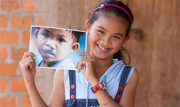 Triển khai chương trình Phẫu thuật dị tật vùng hàm mặt cho trẻ em. 