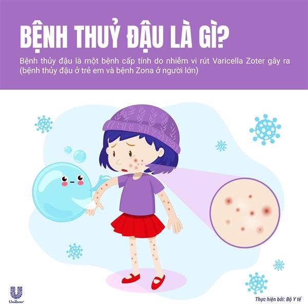 BỆNH THỦY ĐẬU NHỮNG ĐIỀU CẦN BIẾT