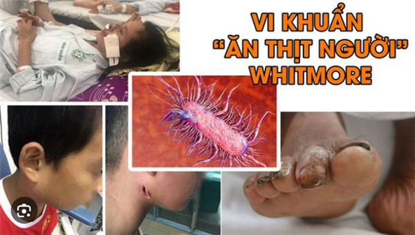 V/v tăng cường công tác truyền
thông phòng, chống bệnh Whitmore