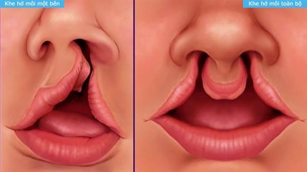 Thông báo triển khai chương trình phẫu thuật dị tật vùng hàm mặt cho trẻ em